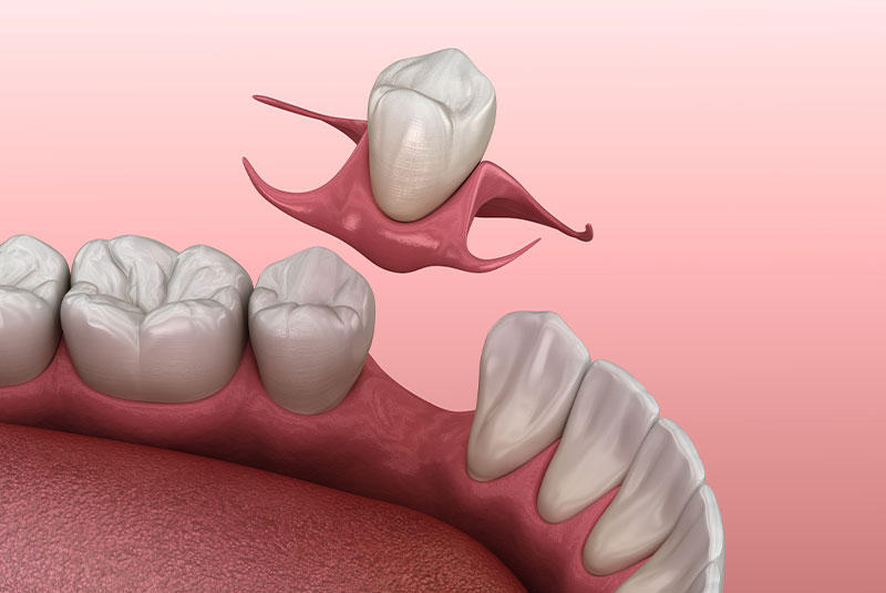 graphic of immediate denture