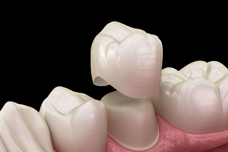 Close up of regular dental crown